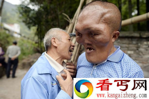 重庆男子患怪病面部增大 神似外星人