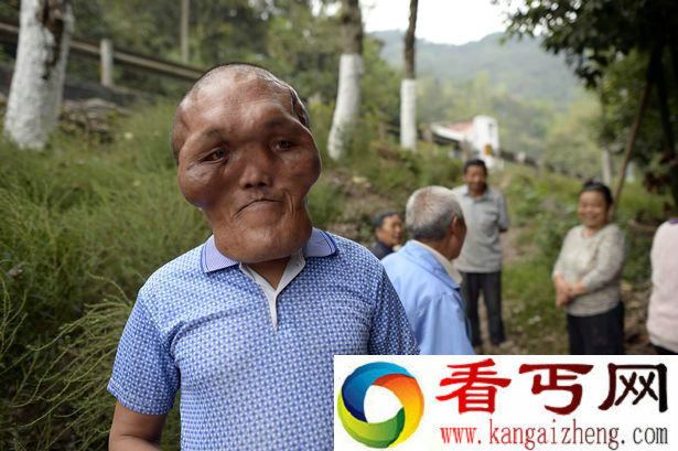 重庆男子患怪病面部增大 神似外星人