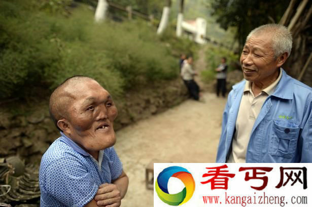 重庆男子患怪病面部增大 神似外星人