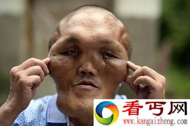 重庆男子患怪病面部增大 神似外星人