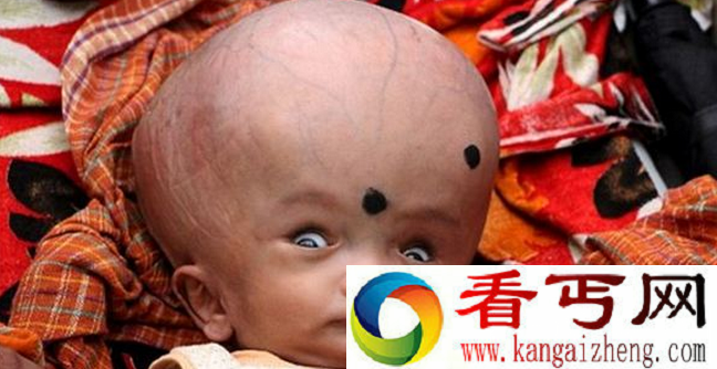 印度男童头部是正常人三倍大 每日呕吐不止
