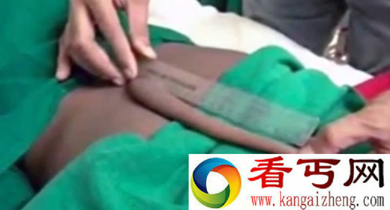 印度男孩青春期竟长出尾巴 长达20cm