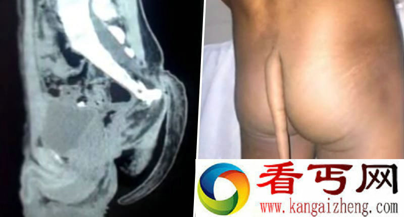 印度男孩青春期竟长出尾巴 长达20cm