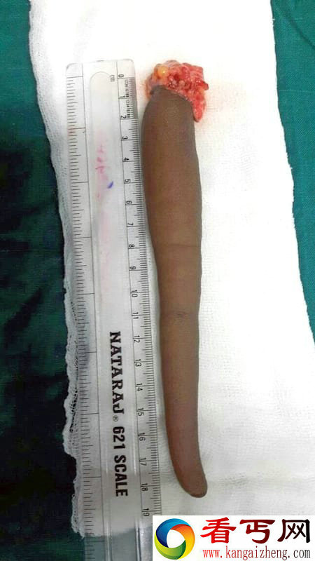 印度男孩青春期竟长出尾巴 长达20cm