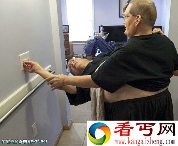 连体人能活多久?世界最长寿连体人63岁