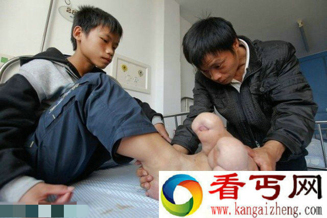广西瑶族14岁男童患罕见"大脚症 巨足脚趾大如小腿