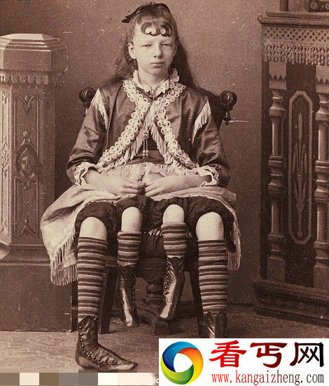 摄影师拍摄纽约19世纪怪异畸形秀(组图) 美国两百年前怪异畸形秀 长四条腿女孩狗脸男孩