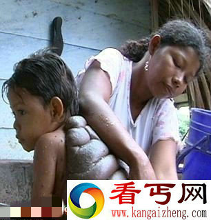 小男孩后背长出神似龟壳的巨型赘肉