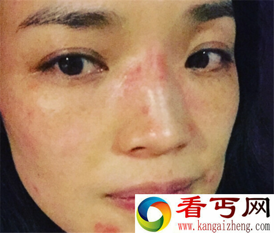 舒淇崩溃晒自拍照 脸部过敏性感女神变成黄脸婆