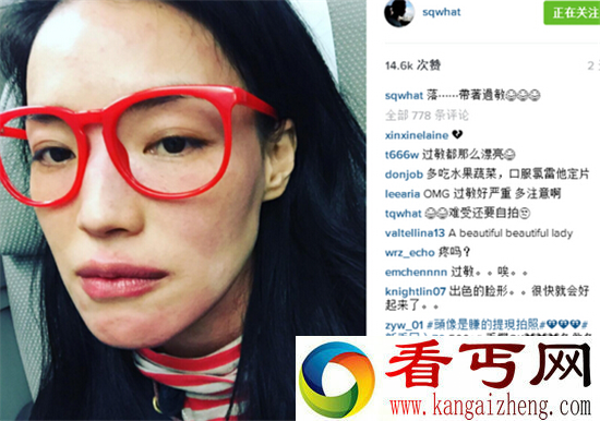 舒淇崩溃晒自拍照 脸部过敏性感女神变成黄脸婆