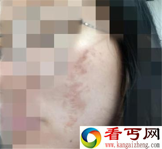 多名大学生毁容 参加丧尸跑活动被商家坑惨