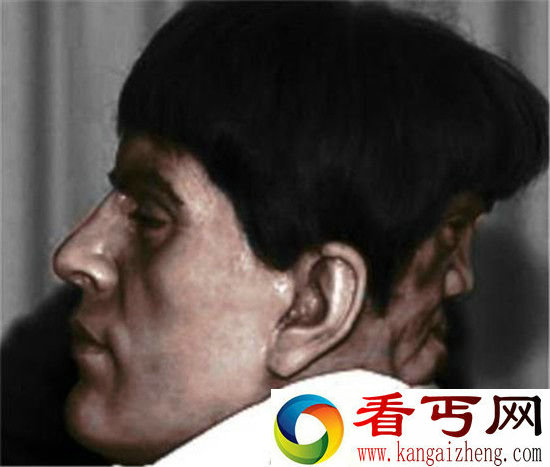 双面人为何拥有两张脸 全世界只有三人
