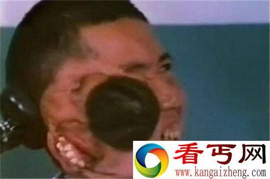 双面人为何拥有两张脸 全世界只有三人
