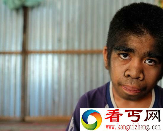印尼狼孩自认被神选中 拒绝接受治疗