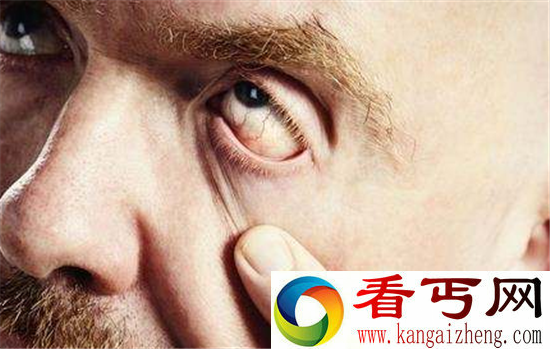 货车司机睫毛里爬出3条虫 真相令人震惊