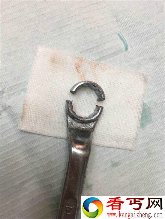 男子下体被扳手套住17小时 最终被口腔科医生拯救