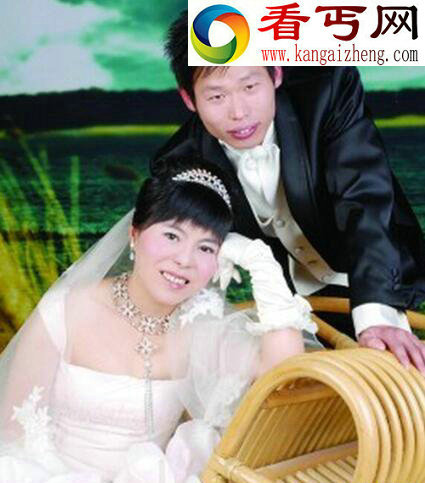 无鼻女3岁被老鼠咬掉鼻子,整形后蜕变准新娘