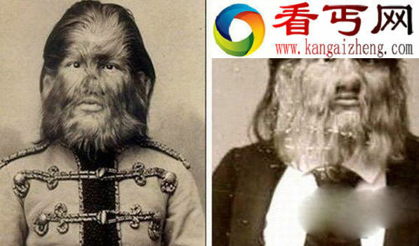畸形人代言世界历史上十大著名“毛人”