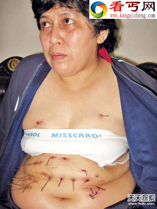 全球三十大怪病女子脚趾不停吐钻石