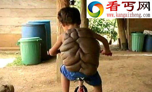 男孩患先天疾病 背上长“乌龟壳”