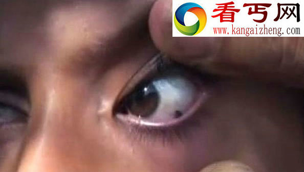 也门一小女孩流罕见的“石泪”
