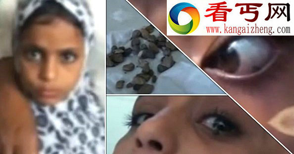 也门一小女孩流罕见的“石泪”
