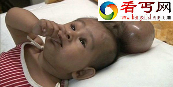 印“双头”男婴摘除2斤脑袋