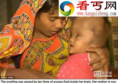 大头“外星人”印度女婴缩头手术整型