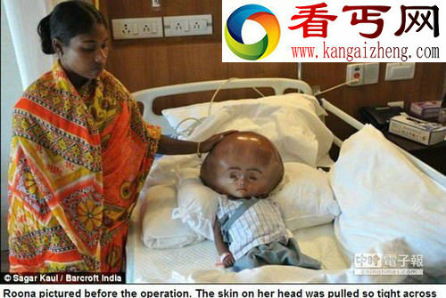 大头“外星人”印度女婴缩头手术整型