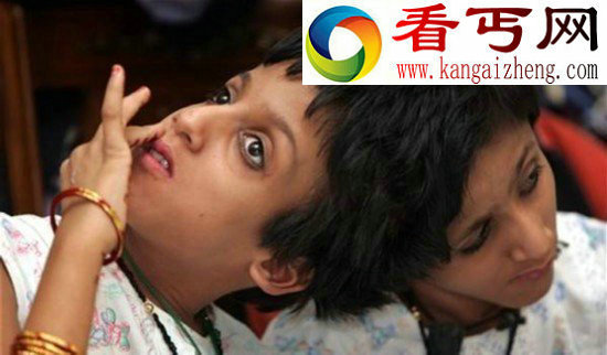 两人一个身体的恐怖变异连体人（组图）