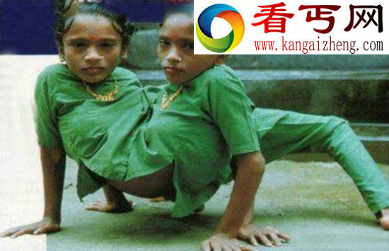 两人一个身体的恐怖变异连体人（组图）