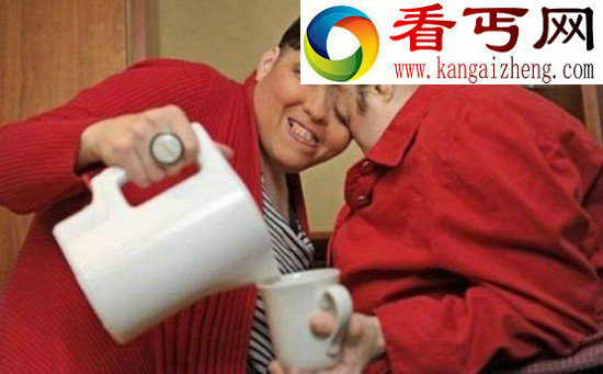 两人一个身体的恐怖变异连体人（组图）
