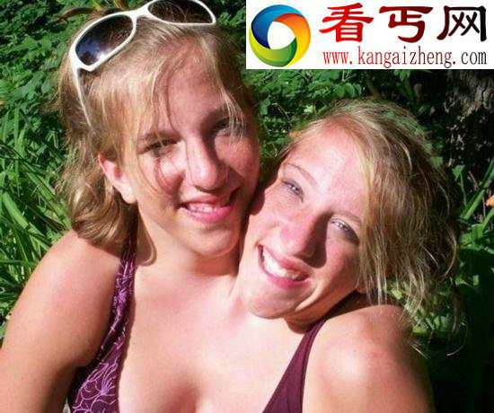 两人一个身体的恐怖变异连体人（组图）