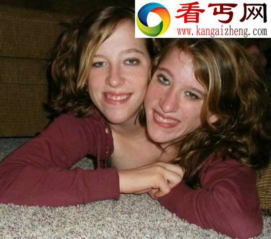 两人一个身体的恐怖变异连体人（组图）