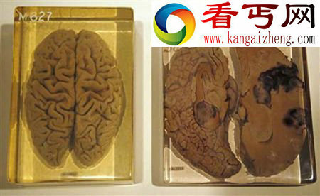 十个奇特的人类大脑事实爱因斯坦的大脑被保留下来