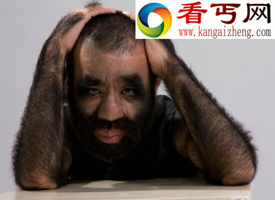 世界毛发覆盖最多的人,于震寰(中国第一毛孩)