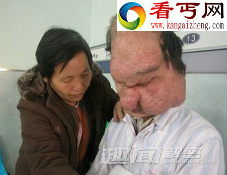 细数全球最恐怖的十大怪病!