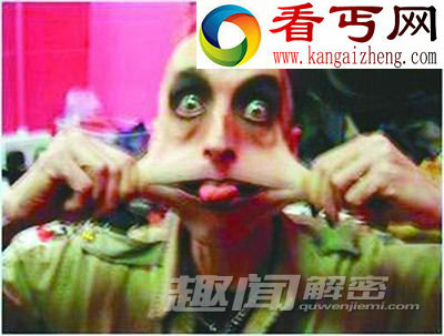 细数全球最恐怖的十大怪病!
