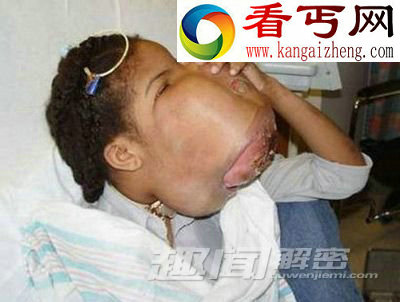 细数全球最恐怖的十大怪病!