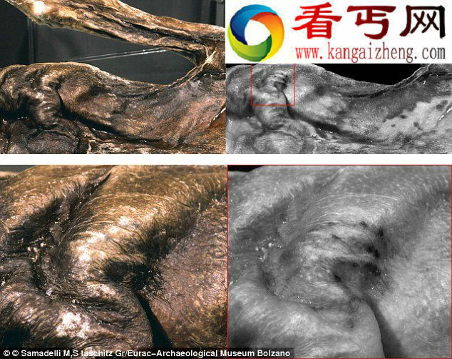 冰人奥茨发现新纹身平行线条似针刺