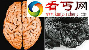 土耳其发现 四千年前人脑