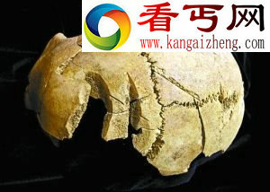 在牛津大学地下发现的这些遗骨头部有撞击形成的裂痕。 牛津大学地下遗骸揭英格兰历史谜题