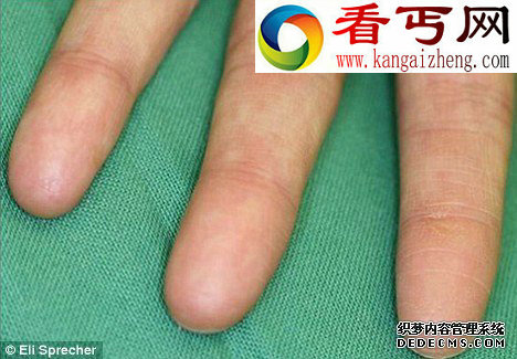 以科学家发现基因突变致少数人天生没有指纹