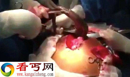 巴西男子肠道内取出活鱼 视频公布引轰动(图)