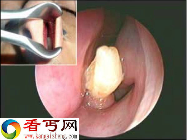 阿拉伯男子鼻子里长牙，为拔牙还得切开鼻子